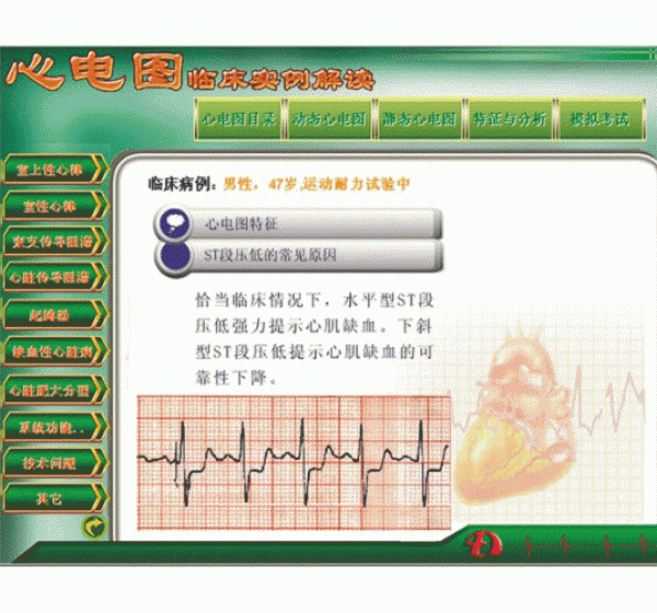 新版心電圖教學(xué)軟件心電圖臨床實(shí)例解讀