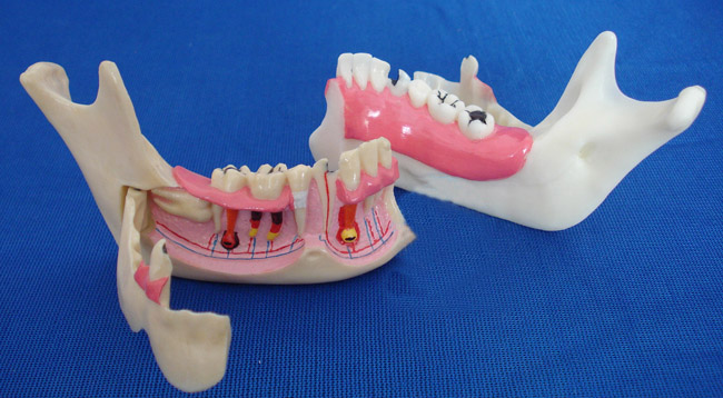 右側(cè)下頜骨組織模型